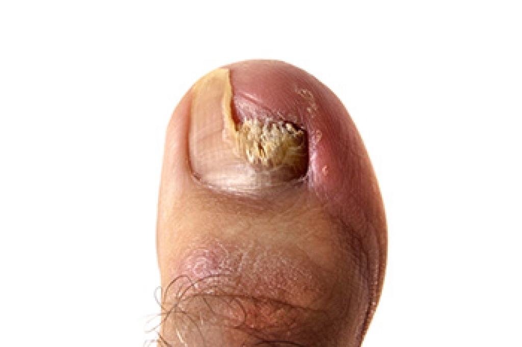Ugly Toenails May Indicate a Fungus