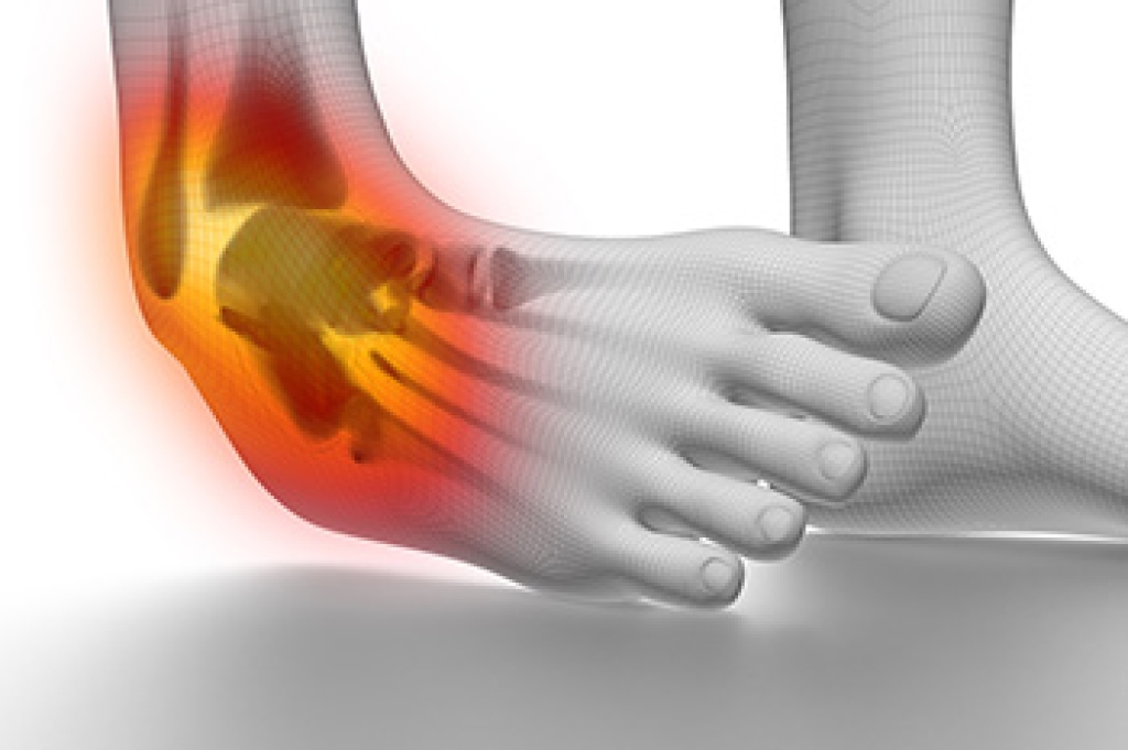 Causes and Grades of Ankle Sprains