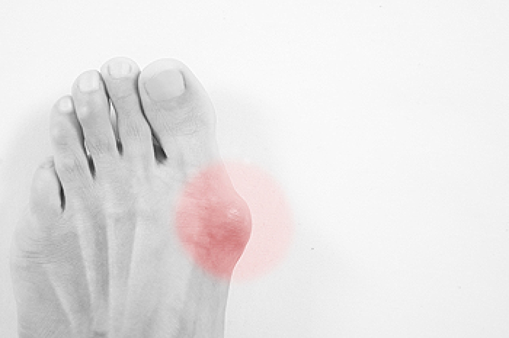 Bunions and Why They Develop