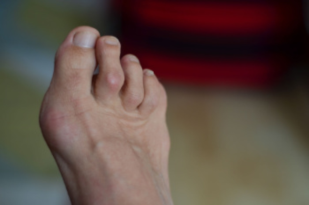 What to Expect From Hammertoe Surgery