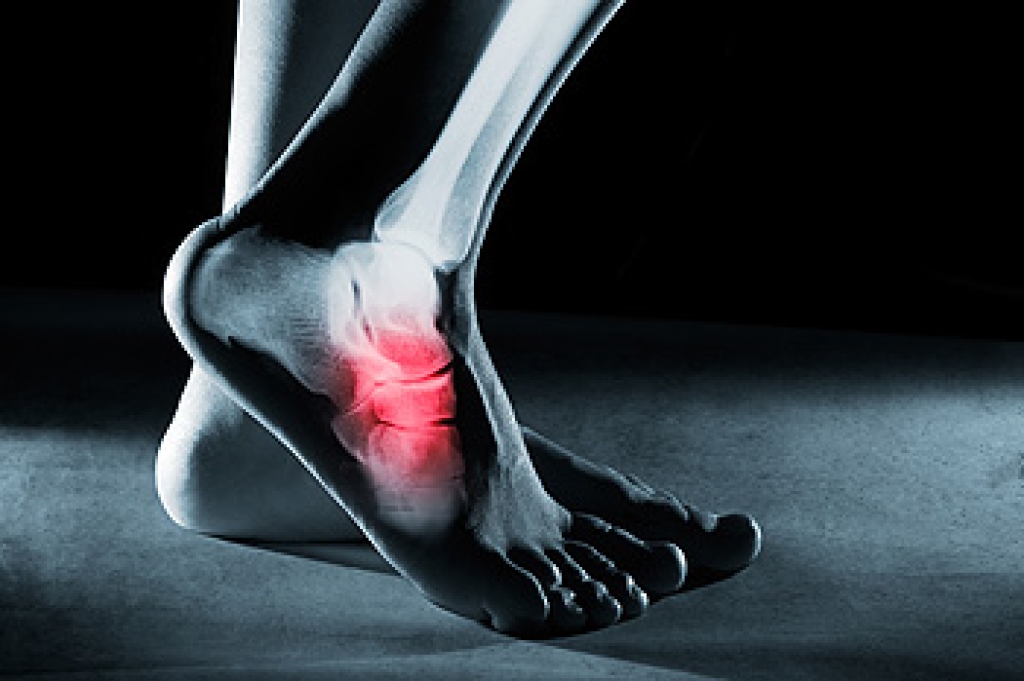 Prevention of Foot Stress Fractures for Active Lifestyles