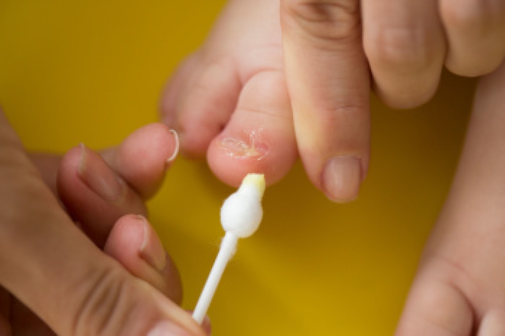 Signs of Ingrown Toenails in Babies